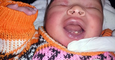 سيدة تضع مولوداً بـ 4 أسنان فى ولادة نادرة بمستشفى سوهاج التعليمى
