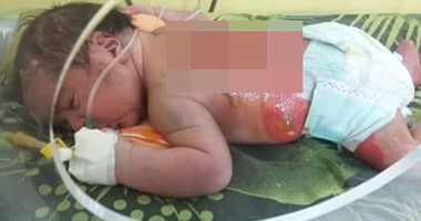 "صحة الإسكندرية" تشكل لجنة طبية للتحقيق فى حالة الرضيع المحترق داخل حضانة