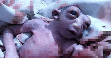 بسبب سوء تغذية الأم.. "الفتاة المعجزة" ولدت بنصف رأس وماتت بعد 48 ساعة