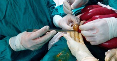 رجل يجرى عملية جراحية لإصابته بتداخل الأمعاء وانسداد معوى بسبب "ليمونة"