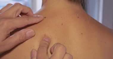 3 أنواع لسرطان الجلد.. تعرف على أسبابه وأهم الأعراض