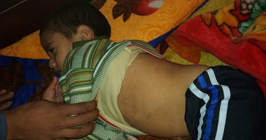 وفاة أول حالة بالحصبة فى بنى سويف لطفل عمره 4 سنوات