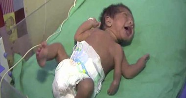بالصور.. إجراء جراحة ناجحة لطفل هندى وُلد بثلاث أذرع