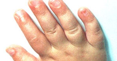 تورم أصابع اليدين مؤشر للإصابة بمرض روماتيزمى
