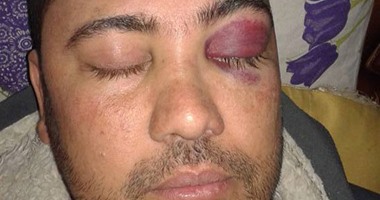 صحافة المواطن.. طبيب يعتدى بالضرب على فنى المعمل بمستشفى سيدى غازى بالبحيرة
