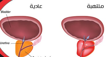 للرجال فقط..4 أطعمة تقلل الإصابة بسرطان البروستاتا أبرزها الرمان والجزر