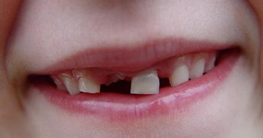 دراسة: المصابون بفقدان الأسنان بجانب أمراض القلب أكثر عرضة للموت المبكر