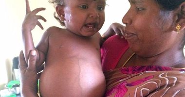 بالصور.. ولادة "جنين فى بطن جنين" لطفلة بالهند