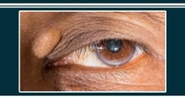 4 علاجات منزلية للتخلص من الكوليسترول السيئ حول العينين