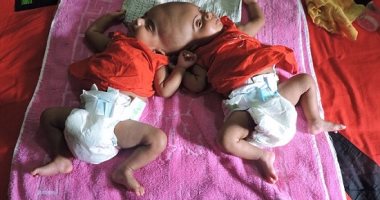 بالصور.. ولادة توأم ملتصق من الرأس فى بنجلاديش والأطباء يؤجلون الفصل