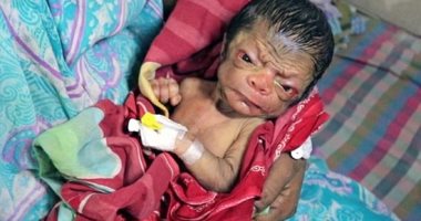 بالصور.. ولادة طفل فى بنجلاديش بوجه عجوز عمره 80 سنة 