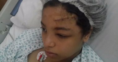 بالصور.. طفلة تصاب بنزيف فى المخ بعد سقوط مروحة فصل المدرسة على رأسها