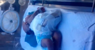 جراحة نادرة لطفل يولد بدون عضلات البطن وجدار المعدة بمستشفى المنيا