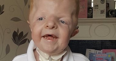 بالصور.. طفل يحارب مرضًا نادرًا يسبب شكلاً "غير منتظم" للجمجمة