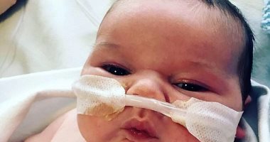 ولادة طفل بنصف قلب فى بريطانيا.. وعملية جراحية تبقيه على قيد الحياة