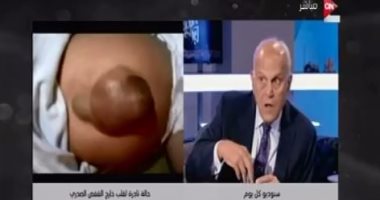بالفيديو.. مجدى يعقوب يتبنى علاج الطفل صاحب القلب خارج قفصه الصدرى ببرنامج عمرو أديب