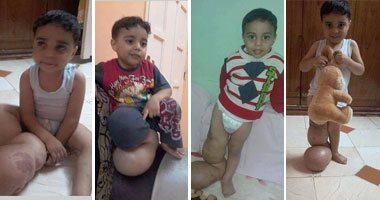 الطفل أحمد مصاب بمرض نادر فى القدم.. وأسرته تطالب بعلاجه فى الخارج 