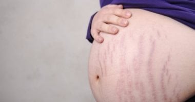 كيف تتخلصين من علامات تمدد الجلد بعد الولادة؟