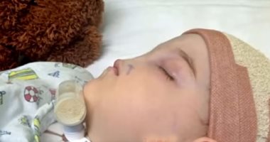 بالفيديو.. أغرب 15 حالة للأطفال حول العالم بين عيوب خلقية وأمراض نادرة
