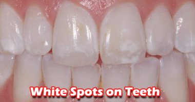 4 أسباب تؤدى لظهور بقع بيضاء على الأسنان "احذرها"