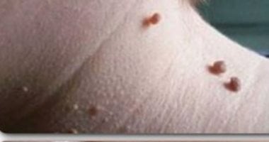 الحمل والسمنة والسكر.. أسباب تؤدى ظهور الزوائد الجلدية وهذه طرق العلاج
