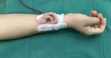 بالصور.. إجراء طبى نادر.. طبيب صينى يزرع أذنًا صناعية بذراع مريض