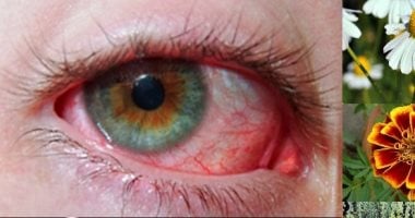 6 أسباب مفاجئة لاحمرار العين أبرزها الإجهاد والتدخين