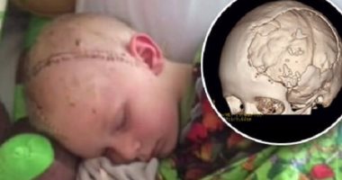 بالصور.. جمجمة 3D تعطى نبض الحياة من جديد لطفل فقد جزءا من دماغه فى حادث