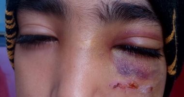 إصابة تلميذة بتورم وكدمات فى العين نتيجة إهمال مدرسة فى الشرقية