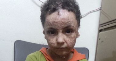 بالفيديو والصور .. والدة طفل شوه الحريق وجهه: المسئولون لم ينفذوا وعود علاجه بالخارج