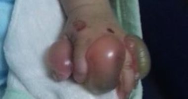 استغاثة طفل.. "الفقاعات الجلدية" مرض نادر يصيب آدم 