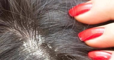4 وصفات طبيعية تخلصك من قشرة الشعر.. تعرفى عليها