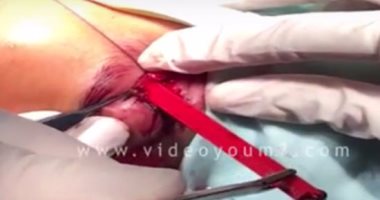"معجزة طبية" بالفيديو.. استخراج قلم رصاص استقر بمخ طفل من عينه  