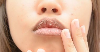أستاذ جلدية: التنفس من الفم ليلا أبرز أسباب جفاف وتشقق الشفاه - اليوم السابع