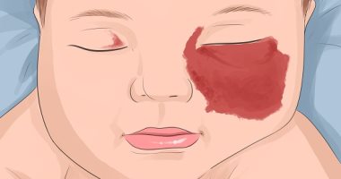 الوحمات الدموية لحديثى الولادة.. الأسباب وطرق العلاج