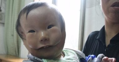 بالصور.. مرض نادر يصيب طفلا صينيا ويطلق عليه "الصبى ذو الوجهين"