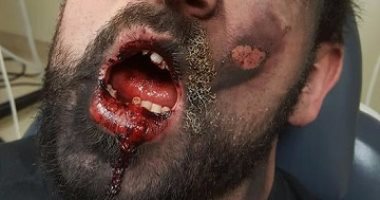 بالصور.. سيجارة إلكترونية تنفجر فى فم رجل وتدمر 7 من أسنانه وتحرق وجهه