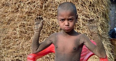 بالصور.. مرض نادر يصيب طفل من بنجلاديش ويحوله إلى "حجر"