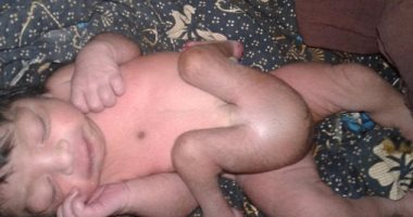 بالصور.. أطباء ينجحون فى إجراء عملية لطفل هندى مولود بـ 4 أرجل