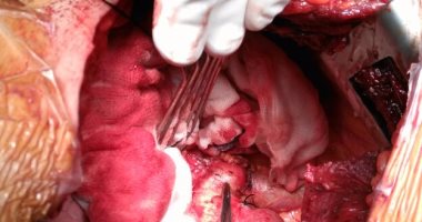 جراح أوعية دموية يكشف أحدث طرق لعلاج أمراض الشريان الأورطى بالقسطرة
