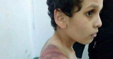 التقرير الطبى لتعذيب سيدة لنجل زوجها بالشروق: مصاب بكدمات وكسر باليد