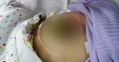 بالصور ..نجاح جراحة فتق سرى لطفلة حديثة الولادة بدمياط