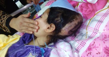 بالفيديو والصور.. إصابة طفلة بغيبوبة إثر جراحتين لاستئصال ورم بكفر الشيخ