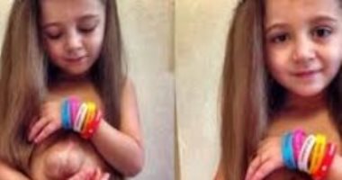 بالفيديو.. "فيرسيفيا" طفلة بقلب خارج القفص الصدرى (تحديث)