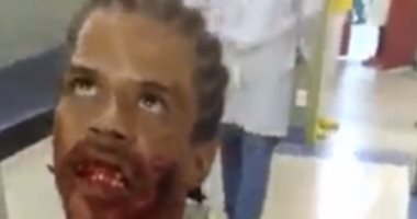 بالفيديو والصور.. "زومبى برازيلى" يرعب الأطباء بإحدى مستشفيات ريو دى جانيرو