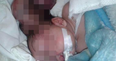 بالفيديو.. نقل طفلة مولودة بثقب برأسها لإجراء أشعة وفحوص