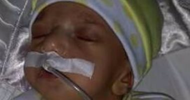 "كارما" طفلة رضيعة مولودة بعيوب خلقية وتحتاج لجراحة خاصة