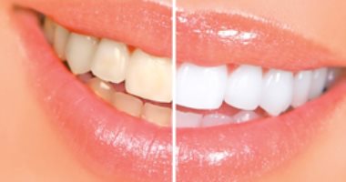 علاج اصفرار الأسنان بطرق منزلية من ضمنها قشر الليمون والبرتقال