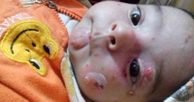 الجلد الفقاعى يهدد حياة الطفل "أدم".. والأب: علاجه يتكلف 1500 جنيه شهريا