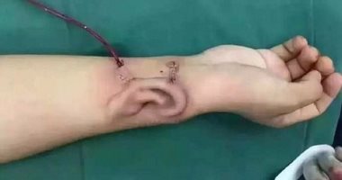 بالصور.. أطباء صينيون ينقلون أذن مريض لرأسه بعد نجاح زراعتها فى ذراعه
